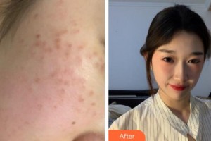 莆田瑞麗整形美容醫(yī)院周萍住院醫(yī)師整形價(jià)格表附超激光美膚祛斑案例展示