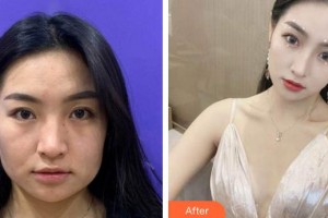 莆田永秀醫(yī)療美容門診部向萌娟整形價(jià)格表附熱瑪吉案例展示