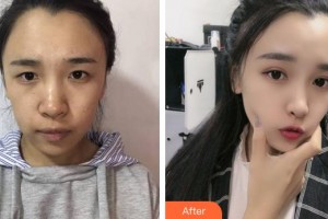 莆田華廈眼科醫(yī)院宋天奇整形價(jià)格表附眼部案例展示