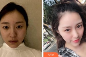 莆田華廈眼科醫(yī)院葉龍玲整形價(jià)格表附眼部手術(shù)案例展示