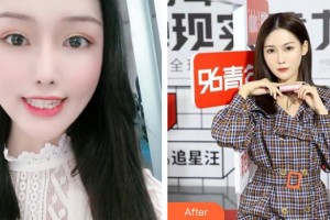 莆田雅美佳口腔醫(yī)院陳亞妹整形價(jià)格表附隱形矯正案例展示