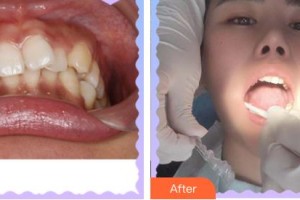 莆田雅美佳口腔醫(yī)院林鳳彬整形價(jià)格表附牙齒矯正案例展示