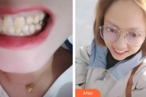 莆田雅美佳口腔醫(yī)院林俊杰整形價格表附口腔案例展示