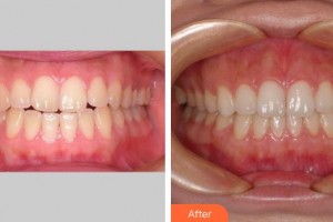 莆田群益口腔門診部黃玉坤整形價格表附隱形矯正案例展示