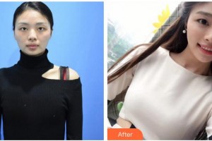 三明市第二醫(yī)院醫(yī)學(xué)美容科陳國章整形價格表附自體脂肪隆胸案例展示