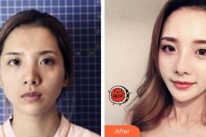 三明市第五醫(yī)院美容整形科許文整形價格表附鼻部綜合案例展示