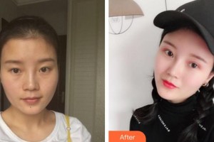 三明歐菲整形美容醫(yī)院何強(qiáng)整形價格表附膨體隆鼻案例展示