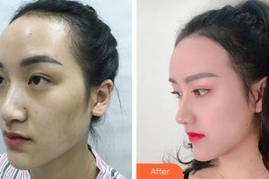 三明萬國美萊醫(yī)療美容外科門診部魏美蓮整形價格表附鼻部手術(shù)+大腿吸脂+脂肪豐胸案例展示