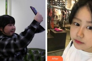 三明市中西醫(yī)結(jié)合醫(yī)院眼科張志廣整形價格表附雙眼皮修復(fù)+鼻部手術(shù)案例展示