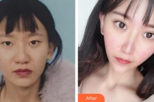 泉州美萊華美整形美容醫(yī)院盧剛整形價格表附鼻部手術(shù)+切開雙眼皮案例展示