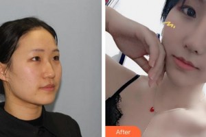 泉州西華醫(yī)療美容醫(yī)院林書燦整形價格表附肋骨鼻部手術(shù)案例展示