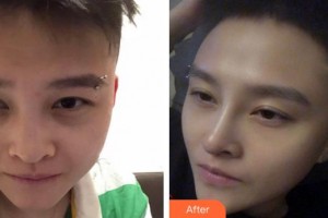 泉州西華醫(yī)療美容醫(yī)院閆保程整形價格表附鼻部手術(shù)整形案例展示