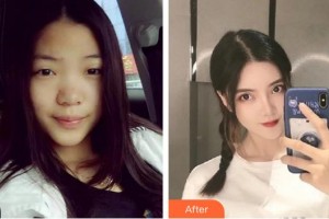 泉州美萊華美整形美容醫(yī)院葉青麗整形價格表附網(wǎng)紅生態(tài)小翹鼻子案例展示