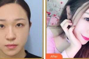 泉州黃氏整形醫(yī)院黃少明整形價格表附鼻部整形案例展示