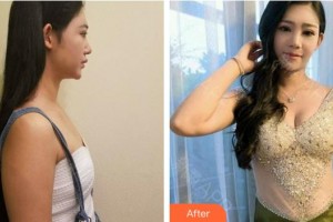 泉州美萊華美整形美容醫(yī)院黃惠銘整形價格表附自體脂肪豐胸案例展示