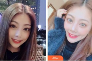 泉州解放軍第180醫(yī)院整形美容中心周劍虹整形價格表附牙齒美白案例展示