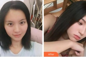 泉州東大整形美容醫(yī)院陳義華整形價格表附鼻部綜合隆鼻案例展示