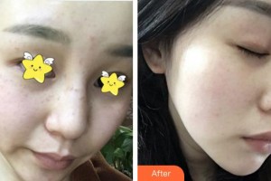 泉州東大整形美容醫(yī)院王雨水整形價格表附超激光美膚祛斑案例展示