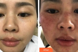 泉州東大整形美容醫(yī)院閔國榕整形價格表附祛斑案例展示