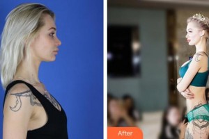 泉州美萊華美整形美容醫(yī)院譚亮整形價格表附假體隆胸恢復(fù)自然案例展示