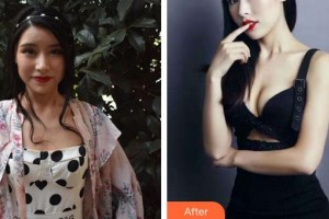 泉州陽光純韓整形醫(yī)院張海帆整形價格表附假體隆胸案例展示