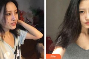 泉州海峽醫(yī)療美容醫(yī)院陳成釗整形價格表附假體豐胸案例展示