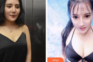 泉州西華醫(yī)療美容醫(yī)院金茶芽整形價格表附自體脂肪隆胸案例展示