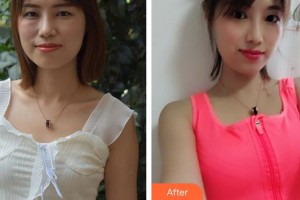 泉州西華醫(yī)療美容醫(yī)院林曉雄整形價格表附假體隆胸案例展示