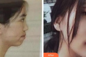 泉州美萊華美整形美容醫(yī)院黃振杰整形價格表附金屬托槽矯正案例展示