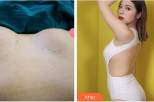 泉州市第一醫(yī)院整形美容外科李迫達(dá)整形價格表附自體脂肪隆胸案例展示