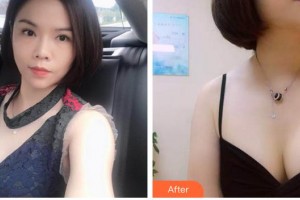 泉州市婦幼保健院整形外科林文雄整形價格表附假體隆胸案例展示