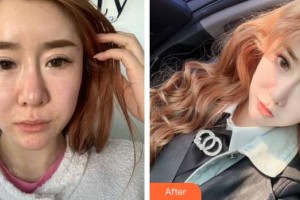 泉州黃氏整形醫(yī)院盧麗華整形價格表附年輕化埋線提升案例展示