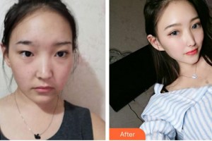 泉州黃氏整形醫(yī)院黃紹華整形價格表附埋線提升案例展示