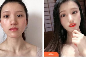 泉州解放軍第180醫(yī)院整形美容中心游龍標(biāo)整形價格表附蜂巢激光美膚祛斑案例展示