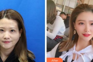 泉州解放軍第180醫(yī)院整形美容中心張如鴻整形價格表附顴骨顴弓案例展示