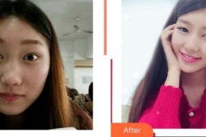 泉州解放軍第180醫(yī)院整形美容中心車麗靜整形價格表附面部吸脂瘦臉案例展示