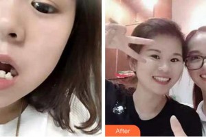 泉州西華醫(yī)療美容醫(yī)院王雪春整形價格表附牙齒矯正案例展示