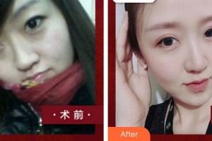 泉州海峽醫(yī)療美容醫(yī)院劉洋整形價格表附雙眼皮修復(fù)案例展示