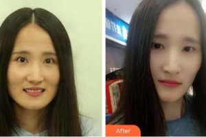 泉州歐菲醫(yī)療美容門診部王忠政整形價格表附瓷貼面案例展示