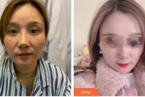 泉州歐菲醫(yī)療美容門診部姚果整形價格表附埋線提升日記案例展示