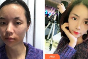 泉州歐菲醫(yī)療美容門診部饒嘉玲整形價格表附多方面部埋線提升案例展示