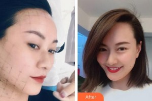 泉州歐菲醫(yī)療美容門診部方暖碩整形價格表附熱瑪吉案例展示