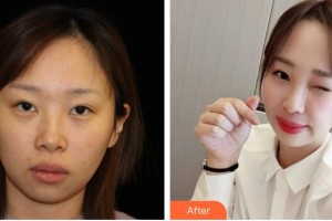 泉州娉娉淑女醫(yī)療美容診所鄭凱整形價格表附熱瑪吉案例展示