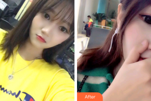 廣州美恩整形美容醫(yī)院鐘苑均整形價(jià)格表附超聲波潔牙案例展示