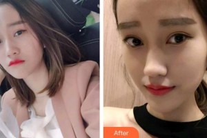 泉州美萊華美整形美容醫(yī)院許曉霞整形價格表附牙齒隱形矯正案例展示