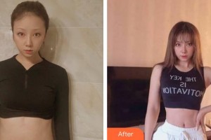 泉州美萊華美整形美容醫(yī)院張旭華整形價格表附疤痕案例展示