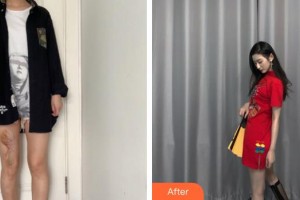 泉州美萊華美整形美容醫(yī)院范偉整形價格表附增生疤痕案例展示