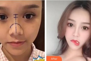 泉州億星醫(yī)療美容門(mén)診部李波整形價(jià)格表附隆鼻案例展示