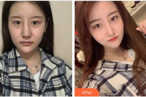 泉州億星醫(yī)療美容門(mén)診部李家廣整形價(jià)格表附半肋鼻部手術(shù)案例展示