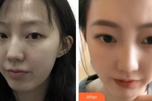 泉州億星醫(yī)療美容門(mén)診部張翼飛整形價(jià)格表附眼部綜合案例展示